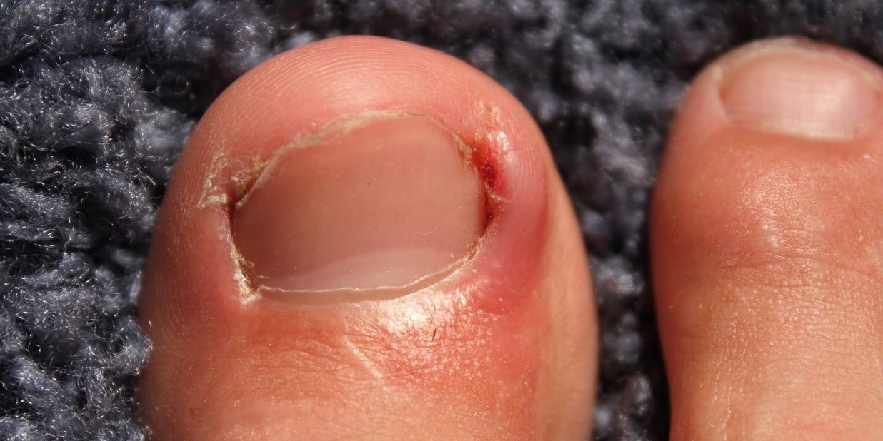 How Did I Get That Ingrown Toenail?